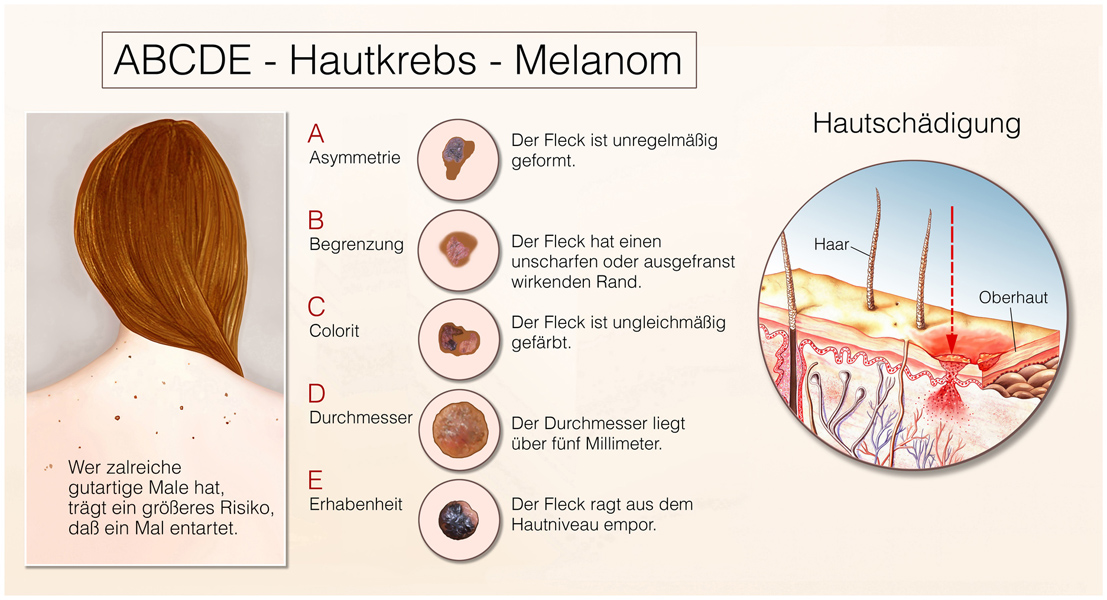 Grafik zum Thema ABCDE - Hautkrebs - Melanom, Foto: © Henrie / Fotolia